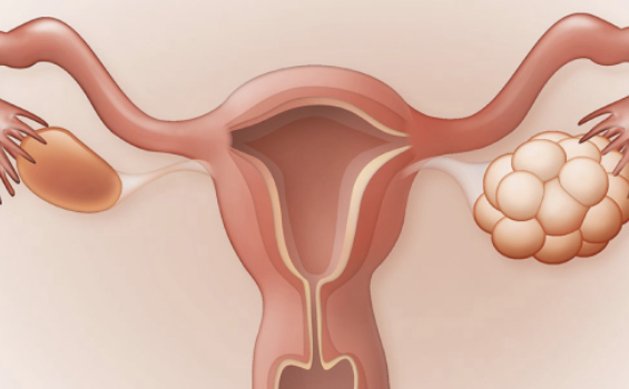 Tratamiento Ovario Poliquístico 