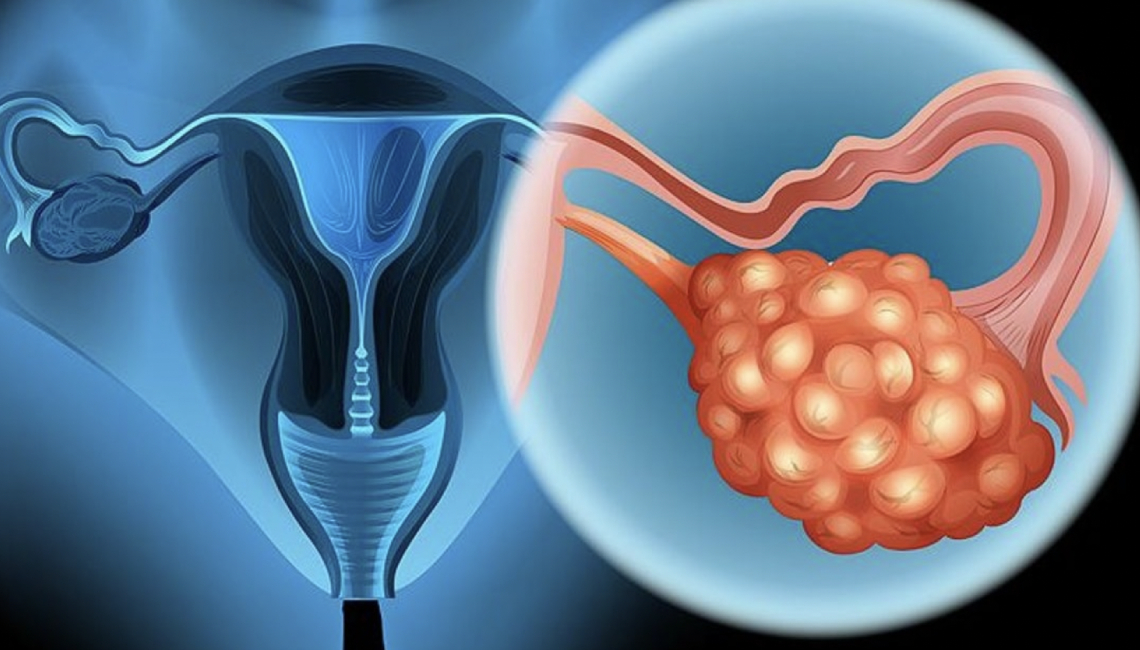 Tratamiento Ovario Poliquístico